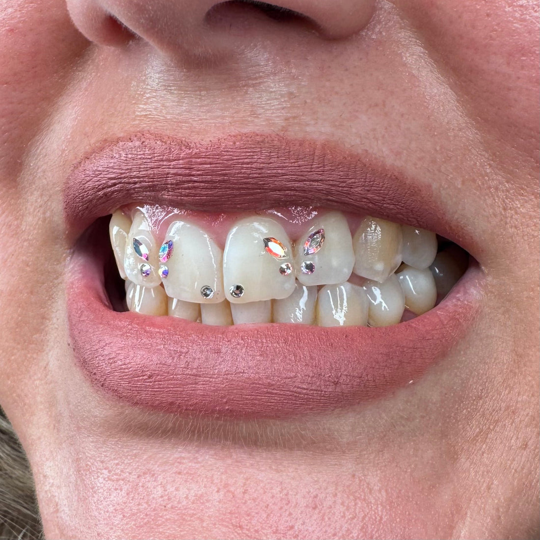 Gemas dentales Barcelona